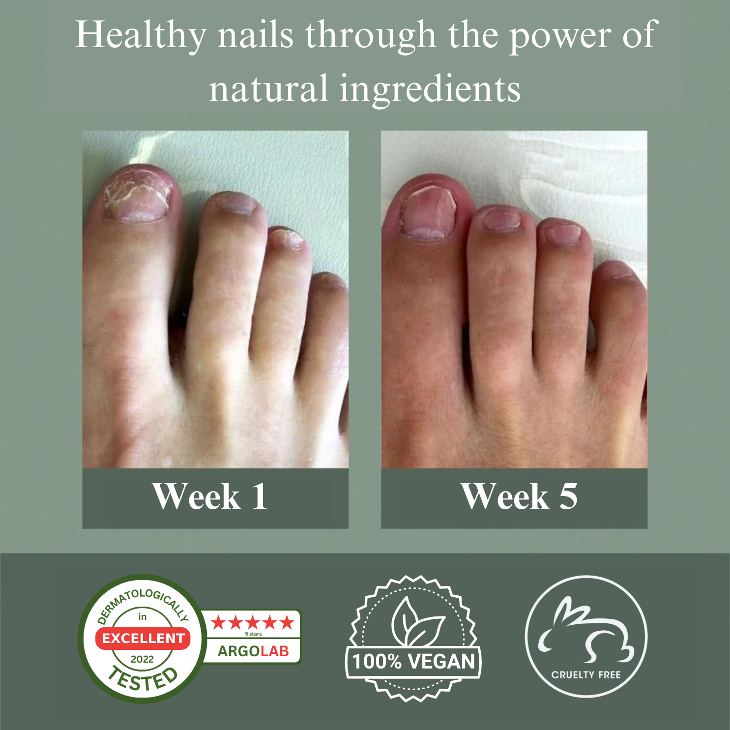 Can Fungal Nail Infection Spread | Apotheco